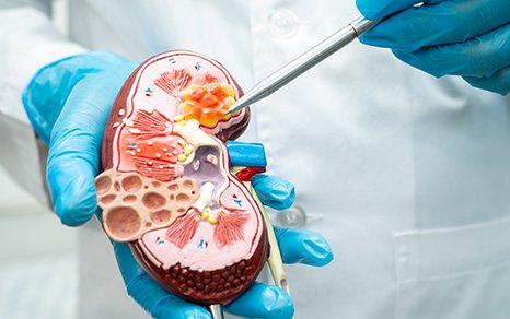 diabetic kidney disease