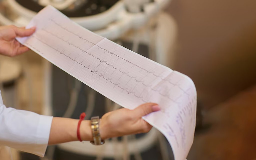 ecg