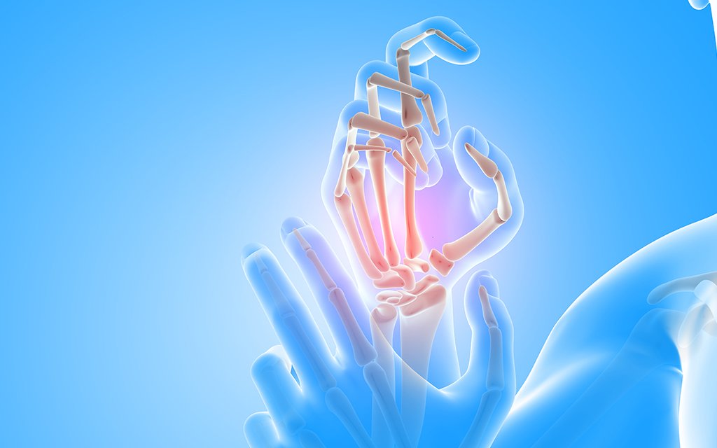 rheumatoid arthritis